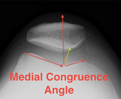 Patella Medial Congruence Angle